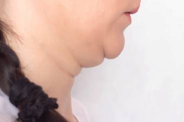 Coolsculpting double chin