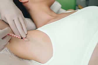 Hyperhidrosis injections in armpit