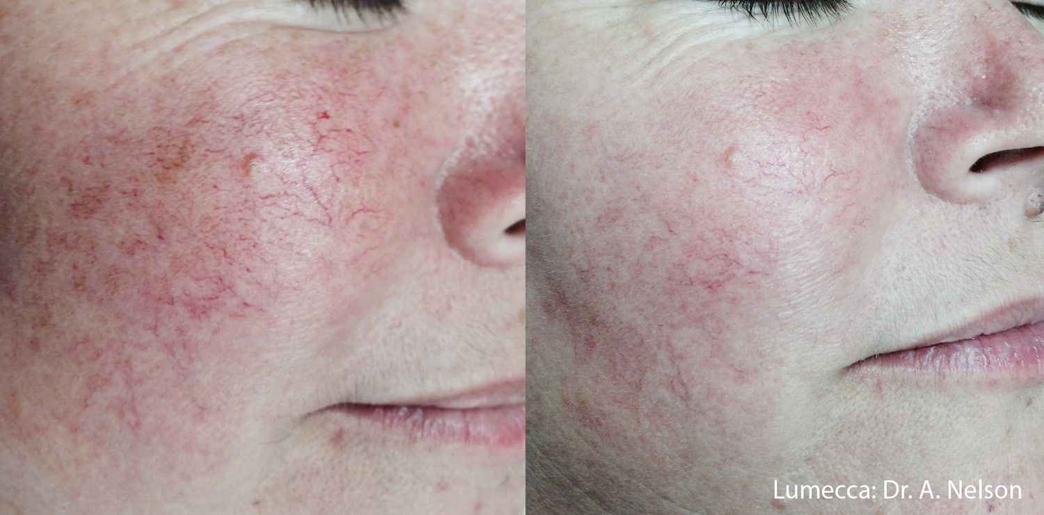 Before and after skin treatment results