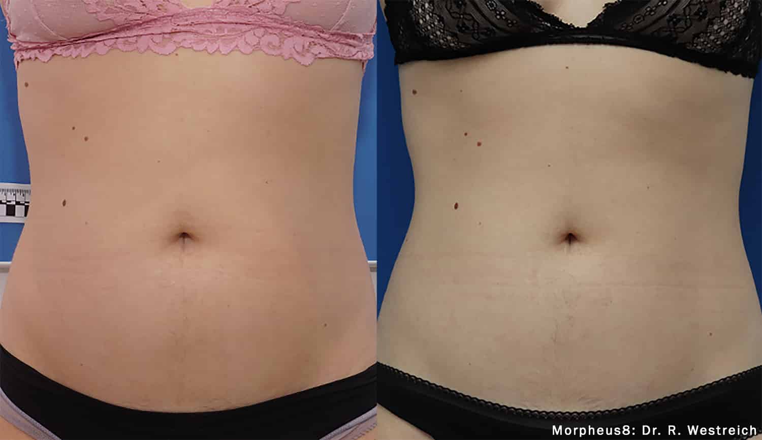 Before and after abdomen treatment results