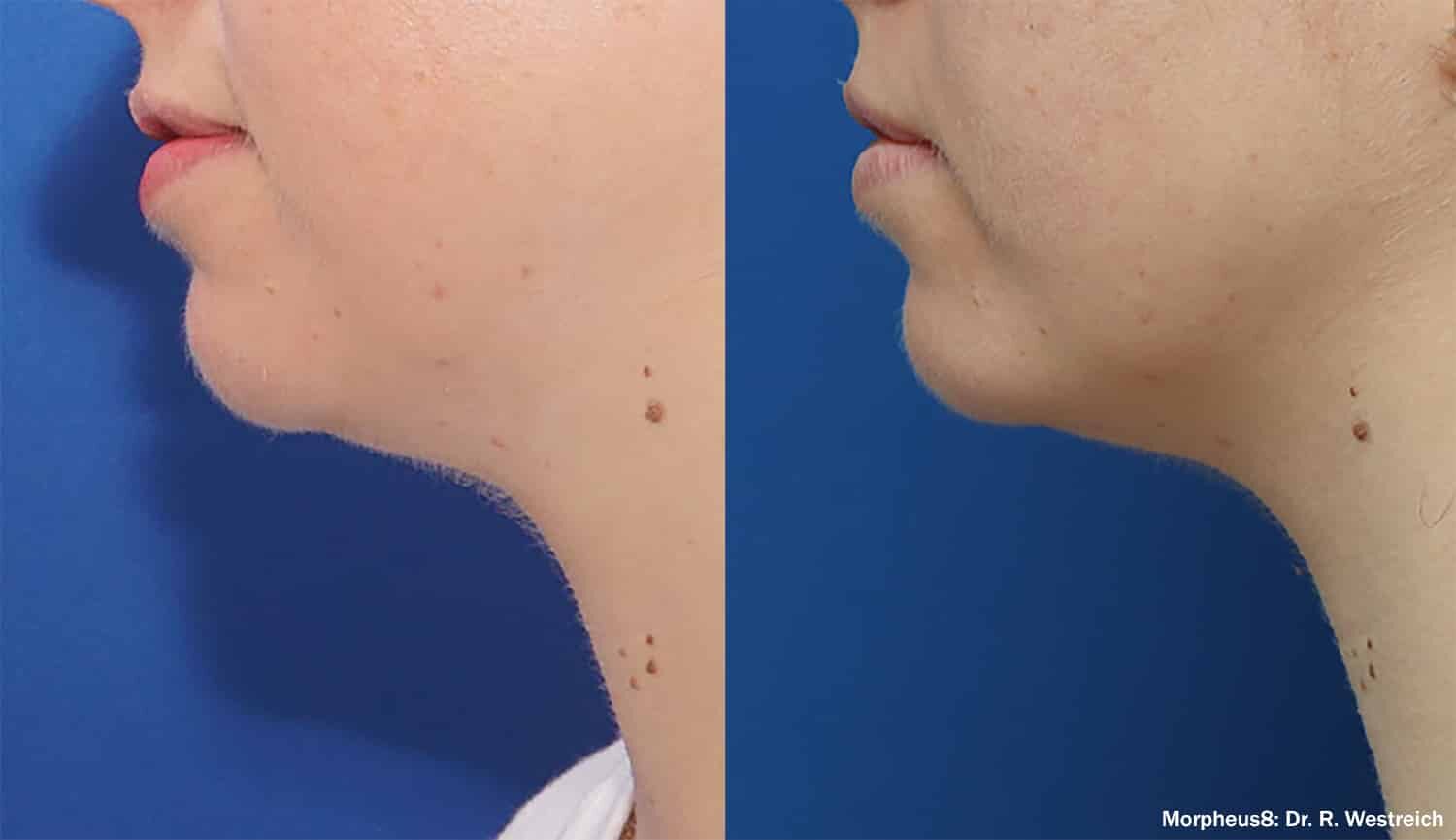 Before and after neck treatment results