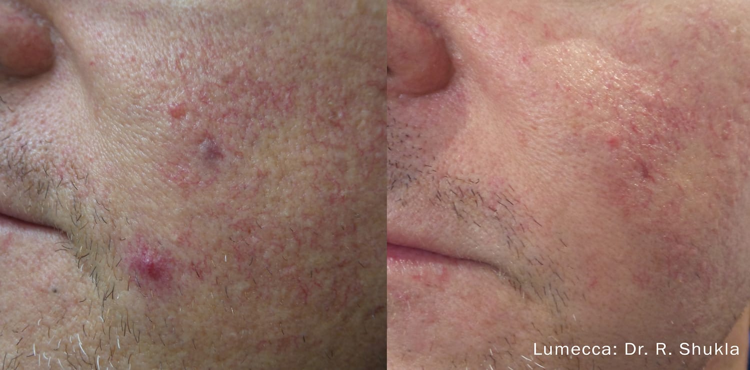 Before and After skin treatment results